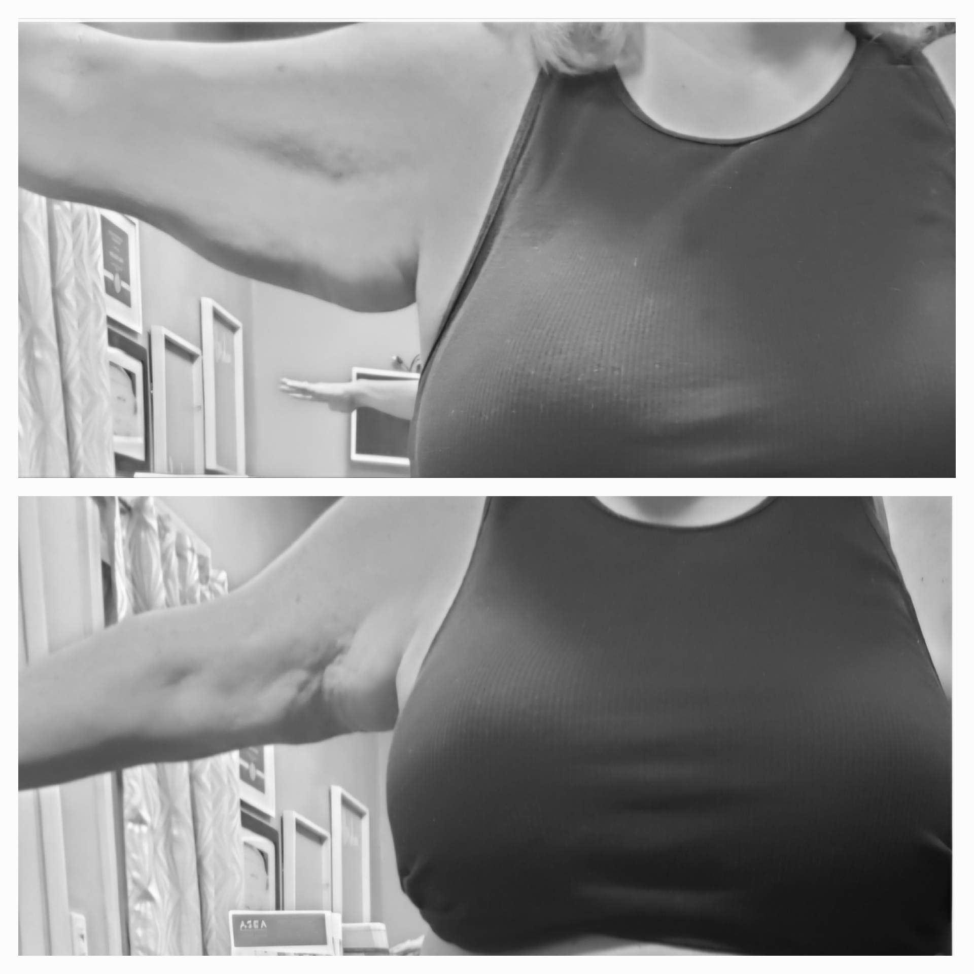 Before and after underarm contouring transformation